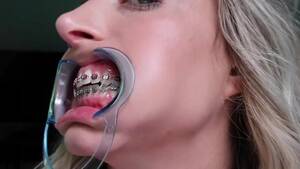 Braces Porn Videos - Braces video 3
