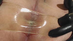 Condom Anal Porn - condom buttplug anal prolapse - XVIDEOS.COM