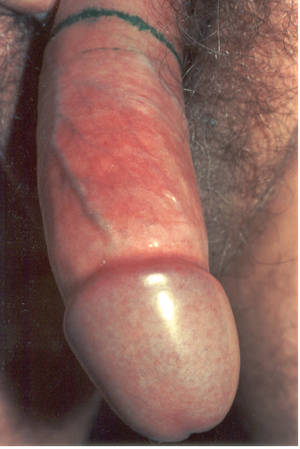 half erect cock - The penis is now fully erect and the band at the top of the penis is now  down near the end of the shaft.