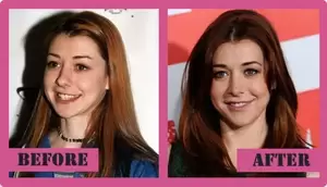 Alyson Hannigan Tit Fuck - Alyson Hannigan's Plastic Surgery - Clinic Mono