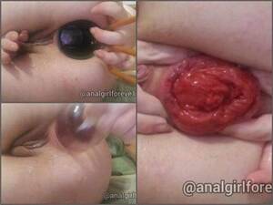 fisting her ass bleeding - Webcam Fisting Anal | Anal Fisting - Analgirlforever Wearing Out My Ass  Prolapse With Blood