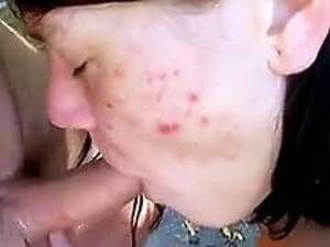 Acne Teen - Acne Girl Blowjob : XXXBunker.com Porn Tube