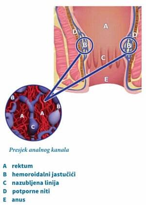 anal thrombosis - Hemorrhoids: treatment and reduction of symptoms that hemorrhoids cause