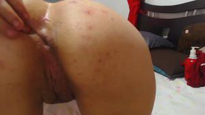 Acne Slut - pimples on ass - XVIDEOS.COM