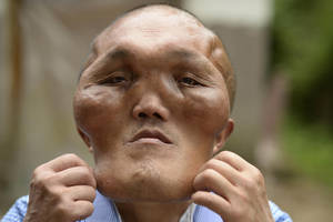 Disfigured Guy Porn - Xia has hyperplasia