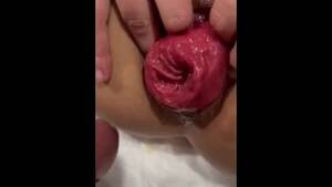 Anal Prolapse Sex Black - Anal prolapse fuck - free Mobile Porn | XXX Sex Videos and Porno Movies -  iPornTV.Net