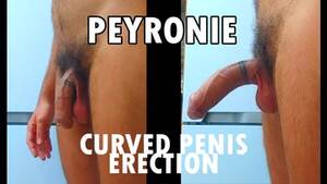 bent dick anal - Erection Process (Curved Penis Peyronie) - ThisVid.com