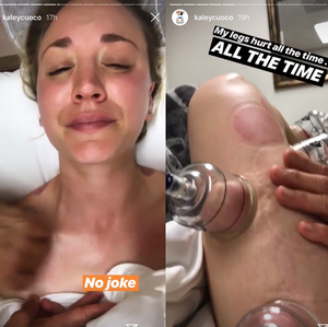 Kaley Cuoco Leaked Sex Tape - Kaley Cuoco Shares Painful Video of Cupping Therapy: Does It Work?