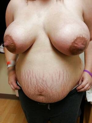 fat stretch marks - Huge Tits in Stretch Marks - 76 photos