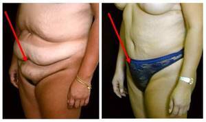 fat upper pelvic area - Pictures showing for Fat Upper Pelvic Area - www.mypornarchive.net