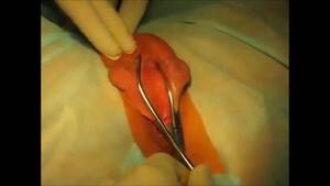 Huge Pussy Lip Removal - Cutting big pussy lips right off - bizarre porn at ThisVid tube