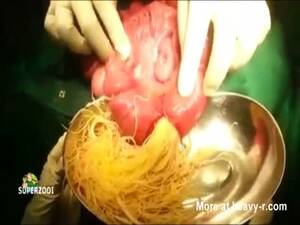 Belly Cut Porn - Man's Intestines Blocked With Parasite Infestation