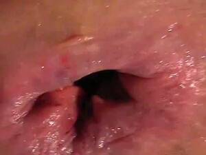 internal anal warts - Anal fucking during pooping - scat porn at ThisVid tube
