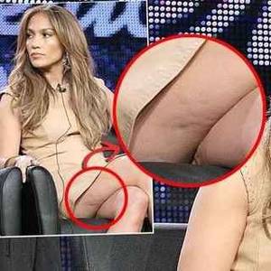 jennifer lopez fat naked lady - Cellulite is caused by fat deposits that are just below the surface of the  skin and usually occurs around the thighs, abdomen and lower pelvic region.