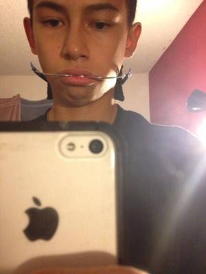 Braces Headgear Porn - Serious headgear boy