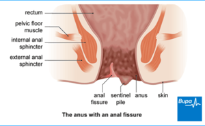 harmful effects of anal sex - Anal Fissure | Bupa UK