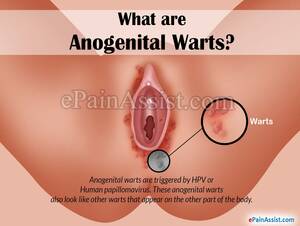 internal anal warts - Anal warts account . New Sex Images.