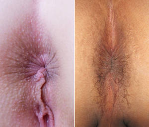 Baby Born With Warts On Anal Area - 