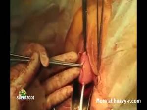 Bleeding Pussy Black - Bloody Pussy Surgery