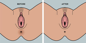 black anal bleach - best anal bleaching cream before and after