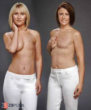 Mastectomy Porn - Amputee Mastectomy Handicapped - ZB Porn