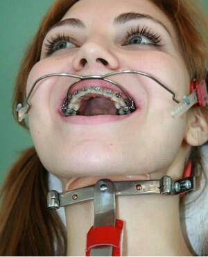Braces Fetish Porn Tumblr - Braces fetish headgear - Hot Naked Pics. Comments: 3