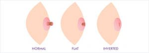 inverted nipples milk - breast causes nipples inverted of