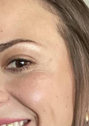 Crow S Feet Porn - Turning 32 so I decided to get Dysport for my crows feet. Before and after!  I am totally in love with these results. Just wanted to share. :  r/30PlusSkinCare
