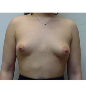 Asian Porn Star Breast Implants - Breast Augmentation Before & After Photo Gallery | Dr. Michael Kreidstein