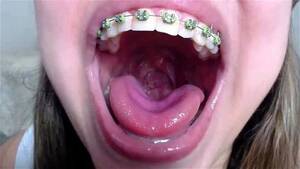 fat teen with braces facial - Watch Hot Mouth Braces Blond BBW Tongue Spit Fetish - Spit, Mouth, Fetish  Porn - SpankBang