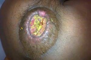 diarrhea from anal sex - 