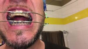 Braces Headgear Porn - Horny Deepthroat Full of Spit with Braces and Double Headgear - Pornhub.com