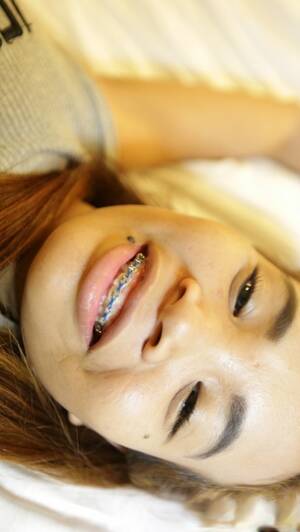 asian braces porn - Asian Braces Porn Pics & Naked Photos - PornPics.com