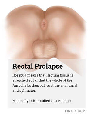 fisting safe - What is a Rosebud? Do you want to develop a Rosebud? - Fistfy