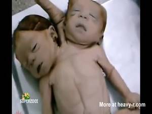 Disfigured Porn Sex - Dead Deformed Baby Bodies