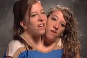 Conjoined Twins Having Sex - World's most famous conjoined twins on dating, learning to drive and  playing sports - Mirror Online