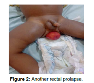anal thrombosis - Journal of Paediatric Medicine & Surgery - Rectal Prolapse in Children: How  Effective is Non-Operative Treatment?