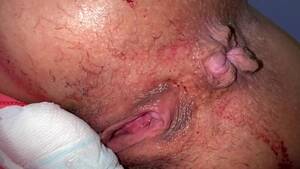 hemorrhoids from anal sex - Hemorrhoids Porn Videos | Pornhub.com
